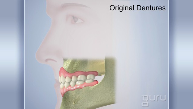 Denture Replacement
